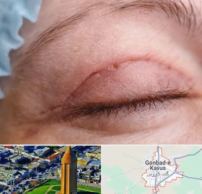 جراح پلک در گنبد کاووس