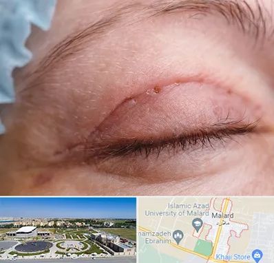 جراح پلک در ملارد