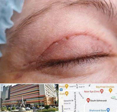 جراح پلک در سهروردی 
