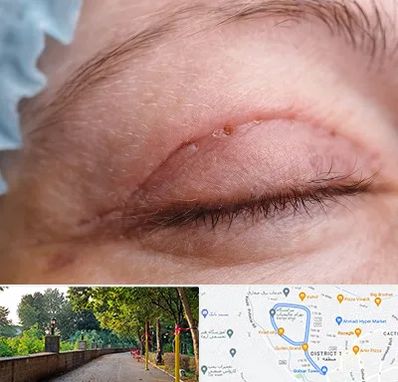 جراح پلک در بلوار گیلان رشت