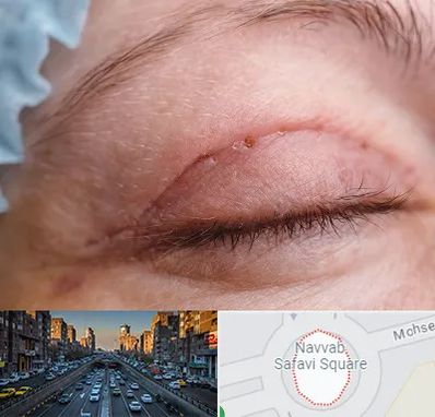 جراح پلک در نواب