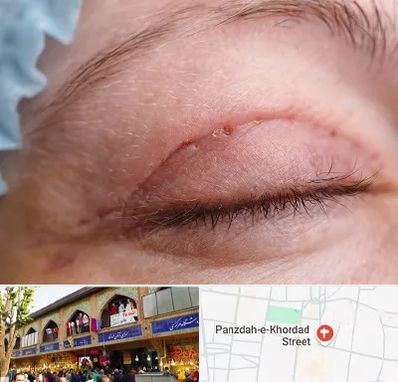 جراح پلک در 15 خرداد