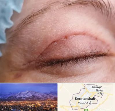 جراح پلک در کرمانشاه