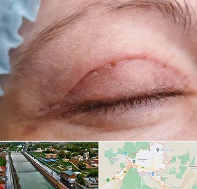 جراح پلک در مراغه