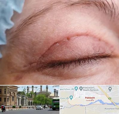 جراح پلک در پاکدشت