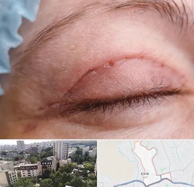 جراح پلک در اوین