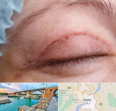 جراح پلک در دزفول