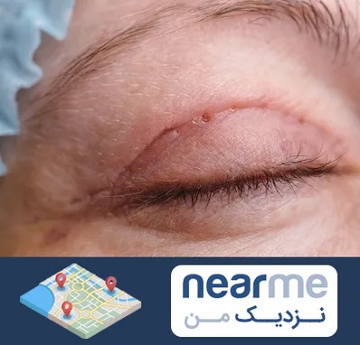جراح پلک در نزدیک من