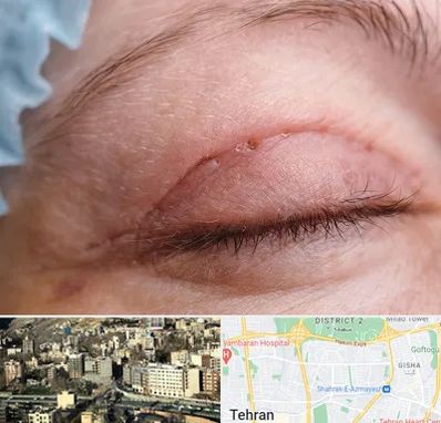 جراح پلک در مرزداران 