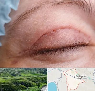 جراح پلک در گچساران