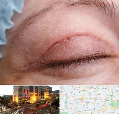 جراح پلک در جنت آباد تهران 