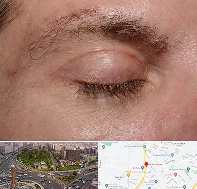 جراح بلفاروپلاستی در سبلان 