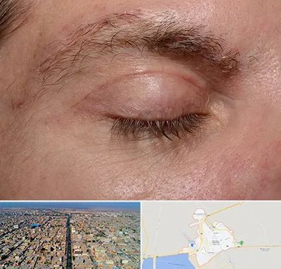 جراح بلفاروپلاستی در بندر ماهشهر