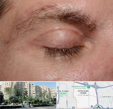جراح بلفاروپلاستی در آپادانا
