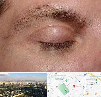 جراح بلفاروپلاستی در هنگام 