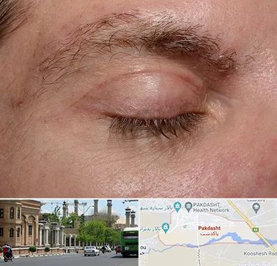 جراح بلفاروپلاستی در پاکدشت