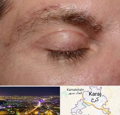 جراح بلفاروپلاستی در کرج
