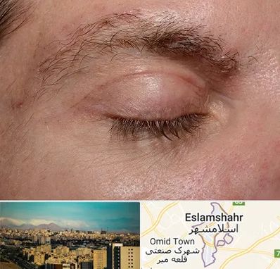 جراح بلفاروپلاستی در اسلامشهر