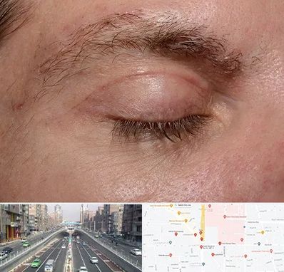 جراح بلفاروپلاستی در توحید 