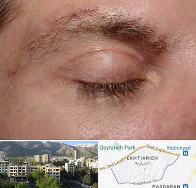 جراح بلفاروپلاستی در اختیاریه 