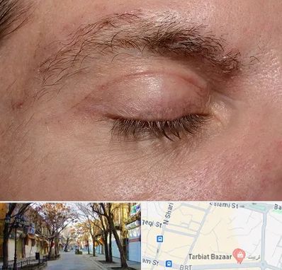 جراح بلفاروپلاستی در تربیت تبریز