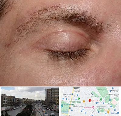 جراح بلفاروپلاستی در بلوار فردوسی مشهد 