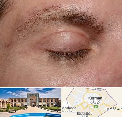 جراح بلفاروپلاستی در کرمان
