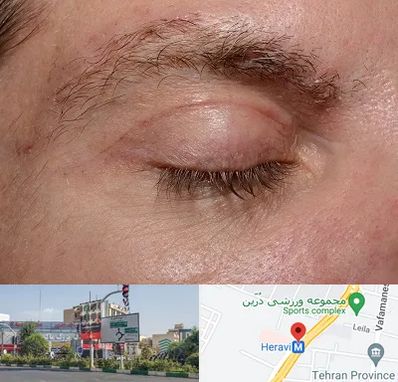 جراح بلفاروپلاستی در هروی 