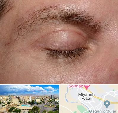 جراح بلفاروپلاستی در میانه