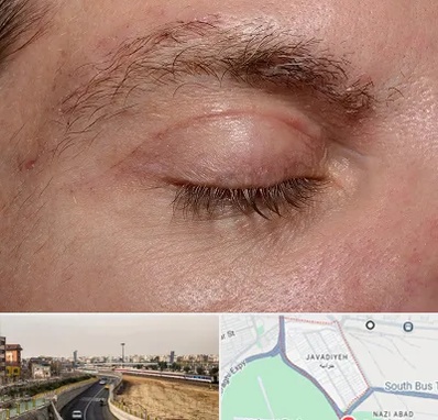 جراح بلفاروپلاستی در جوادیه