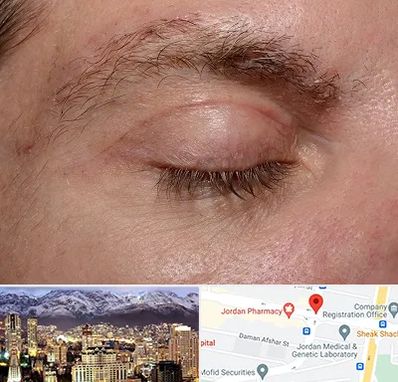 جراح بلفاروپلاستی در جردن 