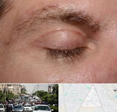 جراح بلفاروپلاستی در سیدی مشهد