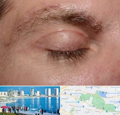 جراح بلفاروپلاستی در چیتگر 