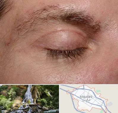 جراح بلفاروپلاستی در الیگودرز