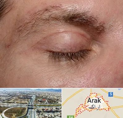 جراح بلفاروپلاستی در اراک