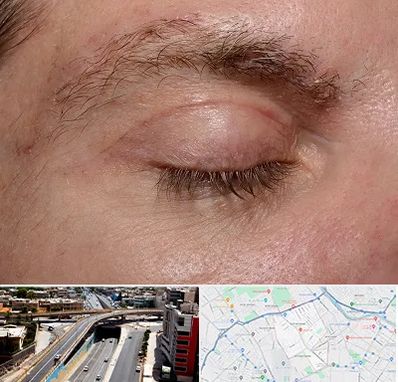 جراح بلفاروپلاستی در ستارخان شیراز