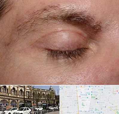 جراح بلفاروپلاستی در منطقه 11 تهران 