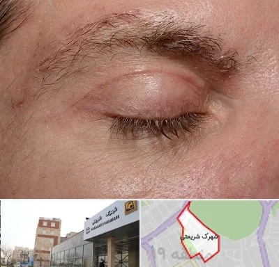 جراح بلفاروپلاستی در شهرک شریعتی