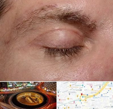 جراح بلفاروپلاستی در میدان ولیعصر 