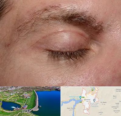 جراح بلفاروپلاستی در مهاباد