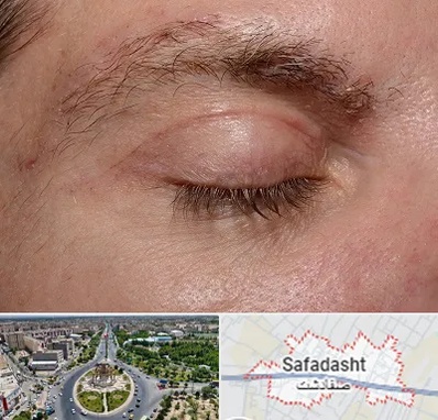 جراح بلفاروپلاستی در صفادشت