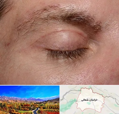جراح بلفاروپلاستی در خراسان شمالی