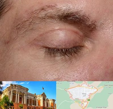 جراح بلفاروپلاستی در خوی