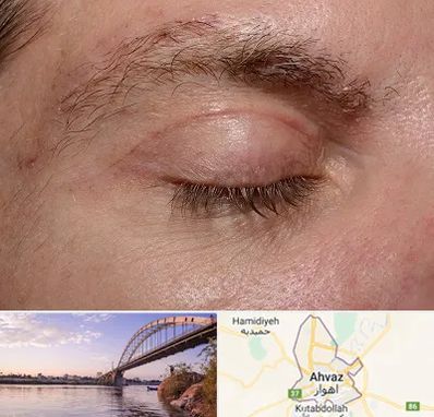 جراح بلفاروپلاستی در اهواز