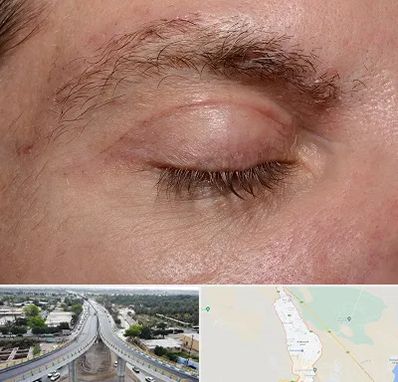 جراح بلفاروپلاستی در اندیمشک