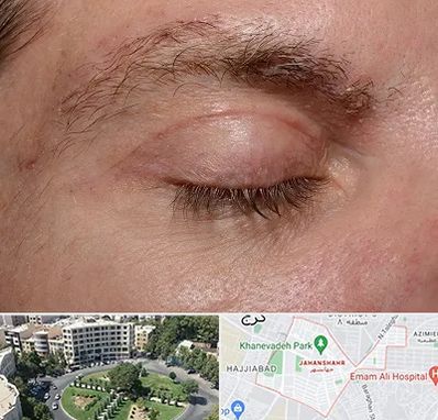 جراح بلفاروپلاستی در جهانشهر کرج 