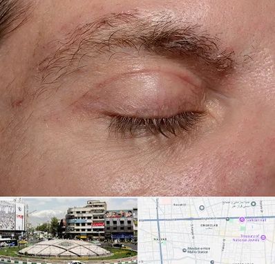 جراح بلفاروپلاستی در مرکز تهران