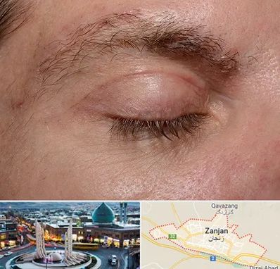 جراح بلفاروپلاستی در زنجان