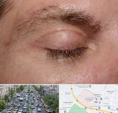 جراح بلفاروپلاستی در گلشهر کرج