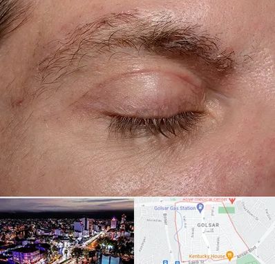 جراح بلفاروپلاستی در گلسار رشت 